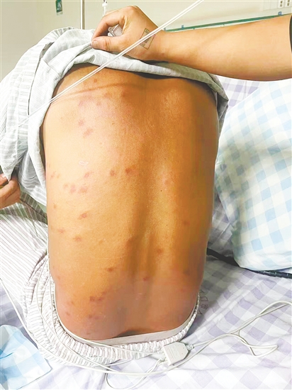 患者全身多處被馬蜂蜇傷。