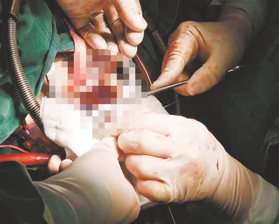 多學(xué)科協(xié)作完成手術(shù)。